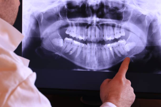 Best Emergency Wisdom Teeth Removal in Laureles, TX