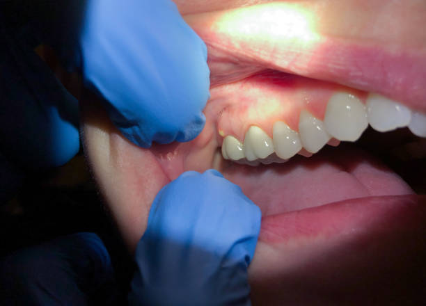 Best Emergency Dental Care for Broken or Chipped Teeth in Laureles, TX